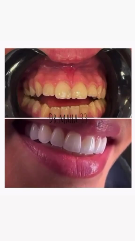 من أعمال عيادتنا 
تعديل الأطباق بين الفكين العلوي والسفلي ب ابتسامه هوليود نوع إيماكس 🦷🔥
التركيبات اللبناني بلون ابيض ساطع 
.
.
.
عنوان العيادة 🦷🤍✨

الرمادي _شارع المستودع _مجمع زهرة اليقطين مبنى الضريبة القديمه نفسها قرب كراج التاميم 
 

للحجز والاستفسار الاتصال ع الرقم: ***********
او مراسلة صفحة العيادة 

أوقات الدوام من الساعة من ١١ صباحاإلى الساعة ٩ ليلا
