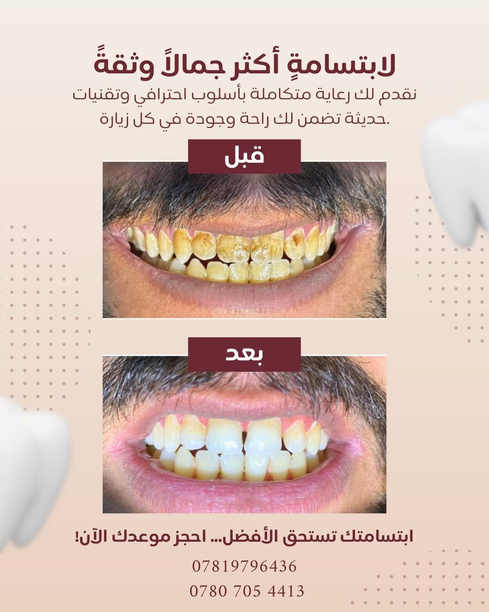 بشرى سارة 🌿

إلى أهالي الغزالية الكرام:

يسرّنا إعلامكم بـ اعلان عروض عيد الفطر المبارك في عيادة طب الأسنان التخصصية د.رسل رعد
 ونعلن عن تخفيض خاص بنسبة 50% ولمدة محدودة يشمل جميع الإجراءات العلاجية:

🔹 الحشوات التجميلية
🔹 حشوات الجذور
🔹 قلع الأسنان الاعتيادي والجراحي
🔹 تقويم الأسنان
🔹 زراعة الأسنان
🔹 تبييض وتنظيف الأسنان

✨ الفحص مجاني

💚تتوفر خدمة العلاج بالأقساط

📍 العنوان: الغزالية – شارع البدالة، مقابل مختبر مختبر اوركيد، مجاور صيدلية صيدلية محمد فليح
📞 هاتف العيادة: ***********
 0780 705 4413
🕓 أوقات الدوام في شهر رمضان المبارك بعد الافطار: من الساعة 7:00 مساءً ولغاية 11:00 مساءً

أهلاً وسهلاً بكم 🌸
صحتكم تهمّنا دائمًا
