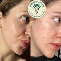 العناية بالبشرة • ريتينول+أحماض • فيتامين C+هيالورونيك