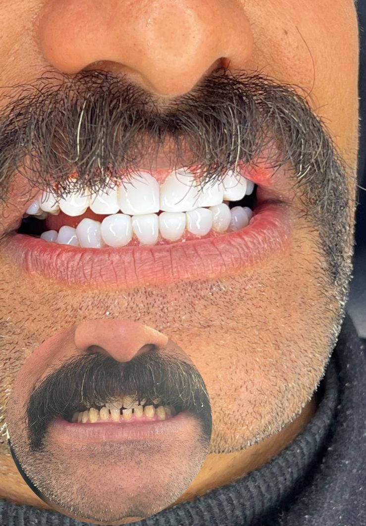 ✨  ابتسامة جديدة لأحد مراجعينا اليوم والنتيجة جداً مميزة
بمناسبة شهر رمضان المبارك 🌙
🔥 عروض خاصة على علاجات الأسنان والتجميل
🔥 نظام أقساط مريح ومناسب للجميع
🔥 أسعار مخفضة لفترة محدودة
لا تأجل علاجك… ابتسامتك تستاهل الأفضل
📍 الأمين الثانية – شارع المهداوي
***********
