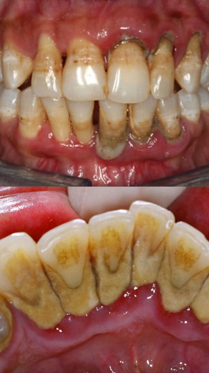 السلام عليكم
يتوفر تنظيف مجاني للاسنان داخل عيادات جامعة المنارة للعنده مثل هاي الحالات يتواصل وياي خاص او ع رقمي ***********
