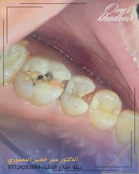 تسوس كلش عميق لكن تم التنظيف بحذر وكان قريب على الجذر خليت مادة تحمي ا...