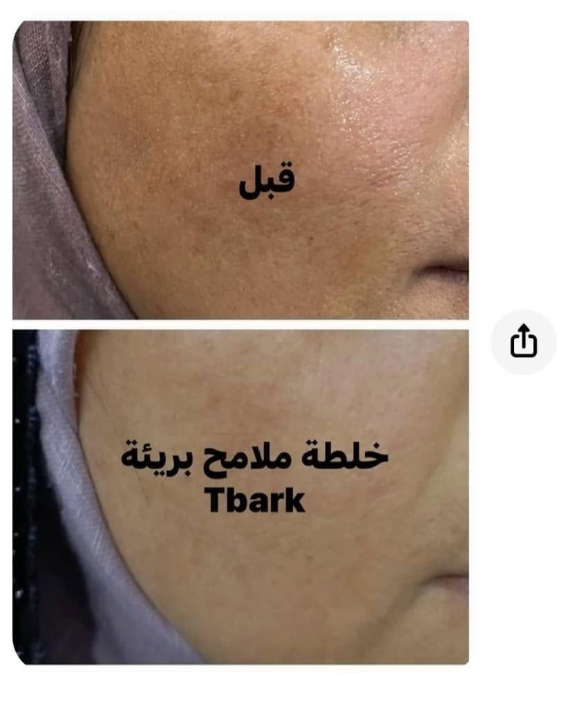تم تجهيز خلطات لتبيض وتفتيح البشرة مع معالجة الكلف والتصبغات  ✨

بدون اي اضرار للبشرة خلي بشرتك اجمل مع خلطة ملامح بريئة
او راسلونا عالخاص


**إذا كنت صاحب هذا الإعلان وتريد حذفه لأي سبب، رجاءا أرسل رسالة إلى الدعم الفني**