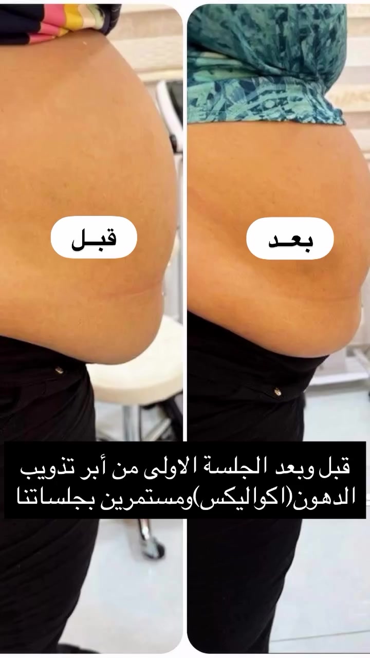 أخصائيـة التغذيـة العلاجيـة لأمـراض السمـنة والنـحافة ومقـاومة الانسوليـن وتكييـس المبايـض وأمـراض الكبـد والجهـاز الهضمـي والكلـى والغـدد الدرقيـة ..
🔵تقييـم الحالـة
🔵وضـع خطـة غذائيـة 
🔵نصائـح وتوجيهـات
🔵عـلاج مقاومـة الأنسوليـن 
‎الـدكتورة #زهراء_عدنان_الساعدي دكتـوراه طـب المجتمـع والتغذيـة العلاجيــة
تتواجـد طيلـة أيـام الأسبـوع ماعدا الثلاثاء و الجمعة )
مـن السـاعة ٧  مساءاٍ
📌رقـم الحجـز 📞***********
📌العنــوان/بغـداد-ساحـة بيـروت -بنايـة الشمـس-مقابـل سيطـرة الأبتسـام ..
#بغداد #العراق #تغذية #السمنة_أضرار_وحلول تكييس_المبايض مقاومة_الأنسولين امراض_الكبد_الدهنية
