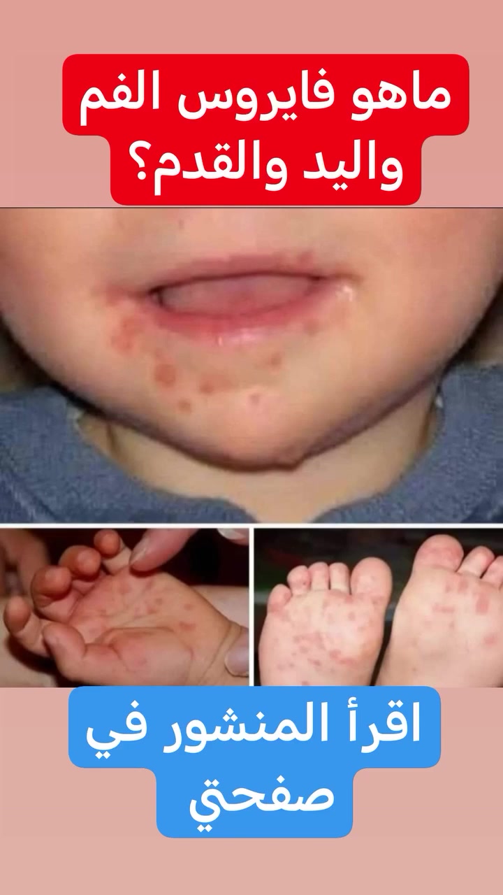 مساء الخير والعافيه

اليوم نسولف عن... 

فايروس كوكساكي A16 ما هو

مرض اليد و القدم و الفم عند الاطفال .

هو عبارة عن عدوى فايروسية حادة شائعة تصيب الاطفال بمختلف الاعمار وتسبب تقرحات بالفم و حكة و حبوب او بثور باليد والقدم (باطن اليد و القدم ) 

الاعراض 🤔🤔

القصة هنا تبدي على شكل تعب ونحول بسيط يصيب الطفل وبعدها تبدي تقرحات بسيطة عطلع بجوف الفم وعلى اللسان مع احتقان البلعوم 

وبعدين  راح تنتشر هذه التقرحات وتبدي تطلع على شكل حبوب او بثور صغيرة تظهر بشكل واضح باليدين و القدم وممكن تنتشر بغير مكان ايضا 
اثناء هذه الفترة الطفل تظهر عليه ارتفاع حرارة وممكن تصعد حرارته لل٣٩ درجة مئوية كذلك يقل طلبه للطعام او الرضاعة 

تتراوح الفترة المعتادة من وقت العدوى الأولية وحتى ظهور العلامات والأعراض (فترة الحضانة) من ثلاثة إلى ستة أيام.

الاسباب 🤔🤔

مثل ما كتبنا بالبداية هذا المرض هو عدوى فايروسية 
السبب الأكثر شيوعًا لمرض اليد والقدم والفم هو الإصابة بفيروس كوكساكي A16. 

طرق العدوى 🤔🤔

يمثل الابتلاع عن طريق الفم المصدر الرئيسي لعدوى فيروس كوكساكي ومرض اليد والقدم والفم. وينتقل المرض عن طريق التعرض لإفرازات وسوائل الشخص المصاب، والتي تتضمن:

* إفرازات الأنف أو الحلق

* اللعاب

* السائل من البثور

* البراز

* الرذاذ التنفسي الذي يعلق في الهواء بعد السعال أو العطس

الوقاية

* اغسل يديك جيدًا باستمرار، خاصةً بعد استخدام المرحاض أو تغيير حفاض الطفل وقبل تحضير الطعام أو تناوله.

 في حالة عدم توفر الماء والصابون، استخدم مناديل اليدين أو مستحضرات الجل المعالجة بالكحول القاتل للجراثيم.

* طهِّر الأماكن المشتركة. احرص على تنظيف الأماكن والأسطح التي يتناوب الكثيرون على استخدامها بالماء والصابون أولاً، ثم بمحلول مخفف مكوَّن من مبيض الكلور والماء.

 يتعين على مراكز رعاية الأطفال مثل الحضانات و رياض الاطفال اتباع جدول صارم لتنظيف جميع الأماكن المشتركة وتطهيرها، وتنظيف كل الأغراض التي يشترك الأطفال في استعمالها كاللعب والدمى وتطهيرها، لأن الفيروس قد يظل موجودًا عليها لعدة أيام. نظِّف لهايات طفلك كثيرًا.

* علِّم أطفالك عادات النظافة الصحيحة. وضِّح لأطفالك كيفية ممارسة عادات النظافة الصحيحة وكيفية الحفاظ على نظافتهم. واشرح لهم سبب منعهم من وضع أصابعهم أو أيديهم أو أي أشياء أخرى في أفواههم.

* اعزل الأشخاص المُعدين. 
يجب عزل المصابين بداء اليد والقدم والفم عن الآخرين عند ظهور مؤشرات المرض وأعراضه عليهم لأنه مرض مُعدٍ جدًا. ويجب أن يبقى الأطفال المصابون بداء اليد والقدم والفم في المنزل وألا يذهبوا إلى دور رعاية الأطفال أو المدرسة حتى تزول الحمى وتُشفى قرحات الفم. 

متى يجب زيارة الطبيب

 قم بزيارة طبيب الاطفال إذا كانت تقرحات الفم أو التهاب الحلق يمنع طفلك من شرب السوائل. واتصل به أيضًا إذا ساءت العلامات والأعراض التي أُصيب بها طفلك بعد أيام قليلة.

دمتم بخير

الدكتور
احمد محمود عبدالله
طبيب الاطفال و الخدج وحديثي الولادة

العنوان
بغداد حي الحسين مجمع التقى الطبي قرب مجمع النمور _مقابل كوزمتك الفرج 

للحجز والاستفسار
***********
فايبر واتساب
