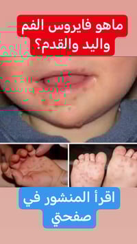 مساء الخير والعافيه  اليوم نسولف عن...   فايروس كوكساكي A16 ما هو  مرض...