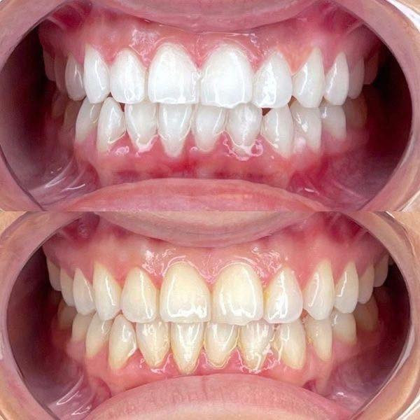 ✨ ابتسامتك تبدأ بأسنان نظيفة وصحية ✨
هل تعاني من اصفرار الأسنان أو تراكم الجير؟  
الآن يمكنك استعادة بياض ابتسامتك مع جلسة تنظيف الأسنان الاحترافية.

🦷 إزالة الجير والتصبغات  
🦷 تلميع الأسنان ومنحها مظهراً لامعاً  
🦷 تحسين صحة اللثة وتقليل رائحة الفم  
🦷 إجراء آمن باستخدام أدوات معقمة بالكامل  

📣تعلن العيادة عن توفر خدمة تنظيف الأسنان مجانًا 

📍 المكان: [كربلاء/ شارع الحر الصغير / عيادات جامعة اهل البيت ]  
📅 الحجز متاح الآن  

لا تؤجل العناية بابتسامتك…  
ابتسامة صحية تعطيك ثقة أكبر كل يوم 💙  

للحجز والاستفسار:  
📞 [***********] 
او المراسلة على الخاص
