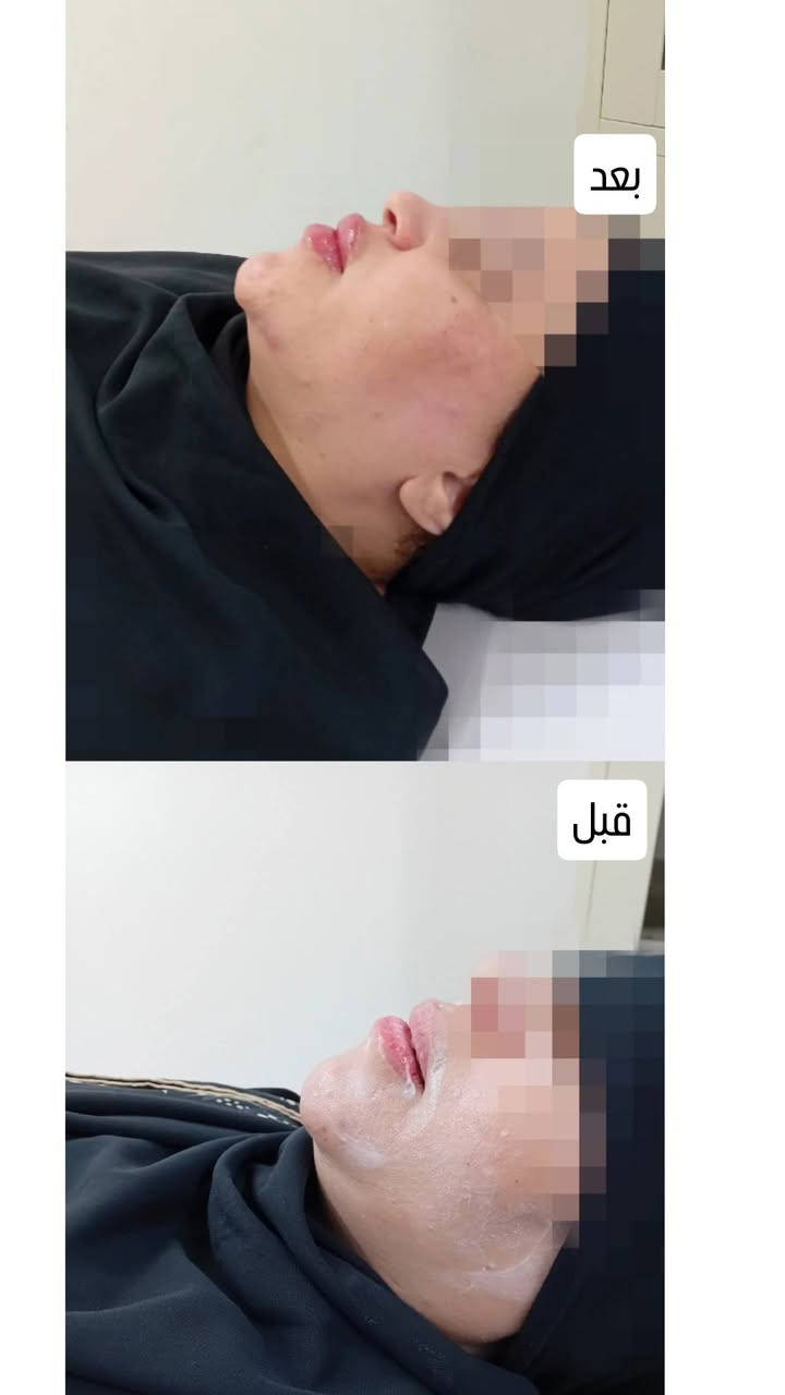✨ عروض التجميل غير الجراحي ✨
لفترة محدودة فقط 🤍
💋 فلر شفايف كوري 45 ألف بدل 60 ألف
💋 فلر شفايف إيطالي 60 ألف بدل 80 ألف
✨ فلر تغيير شامل 175 ألف بدل 225 ألف
💉 بوتكس 100 ألف بدل 125 ألف
🌸 إبر نضارة وتبييض 30 ألف
🐟 إبرة السلمون 70 ألف
🧡 إبرة العنبر 50 ألف
🌿 إبرة التصبغات 35 ألف
🧵 تقطيع ألياف 50 ألف
🧵✨ تقطيع ألياف + إبر نضارة 65 ألف
👁️ بوستر العين لتقليل الهالات 75 ألف
📍 العنوان: بغداد – الزعفرانية – شارع المعهد
Dr. Abyan Abass
📲 للحجز والاستفسار (واتساب):
***********
***********
✨ لا تضيعين الفرصة، احجزي موعدج هسه واستفادي من عروضنا المميزة مع الدكتورة  أبيان عباس 💉🤍
