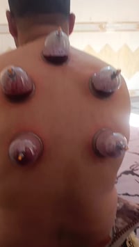 حجامة نبوية • حجامة نسوية • الزعفرانية