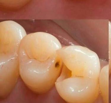 الي عنده مثل هاي التسوسات ومحتاج حشوة او محتاج قلع للاسنان التالفة  العلاج مجاني داخل عيادات جامعة واسط وبإشراف اطباء مختصين تواصلوا وياي عالواتساب ***********
