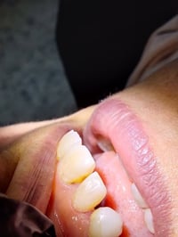 حشوات تجميلية بضمان من عيادتنا🦷❤️  الموقع/ حي 17 الشارع العام لمكتبة ا...