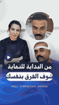 زراعة شعر • زراعة لحية وحواجب • الشطرة شارع دبي