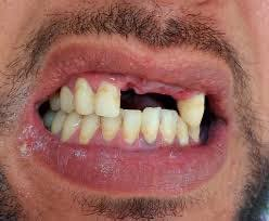 السلام عليكم
تقدم عيادات جامعة الصفوه خدماتها المجانيه
قلع اسنان تالفه وجذور وتعويض ب طقم متحرك 
للتواصل ***********
