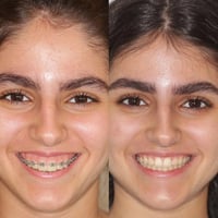 تقويم اسنان • تقسيط مريح • البصرة المطيحة