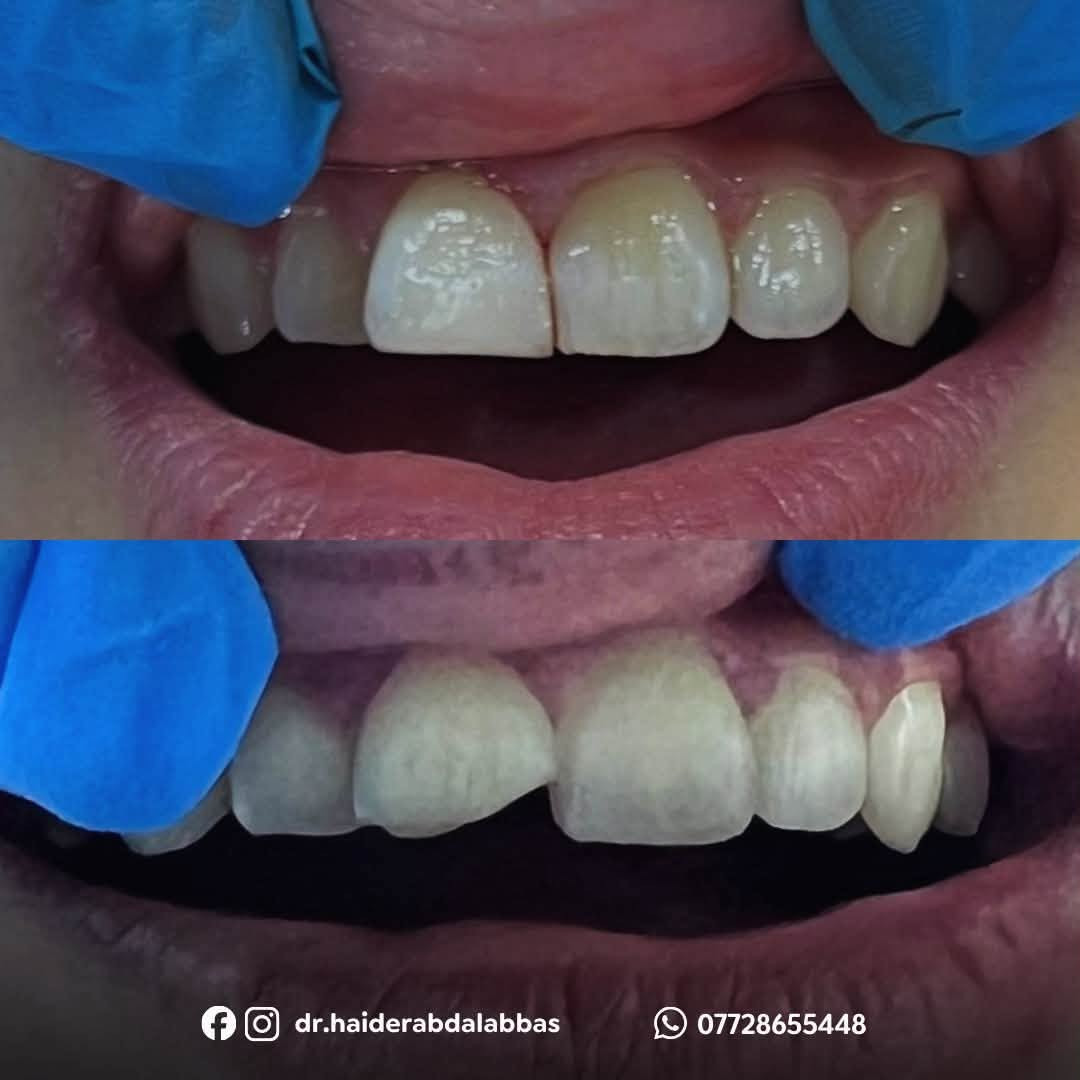 مجانا لفترة المشاية داخل كربلاء
علاج الاسنان بالحشوات التجميلية الدائمية 
للتواصل واتساب *********** 
كربلاء - شارع الحر الصغير - عيادات جامعة اهل البيت
