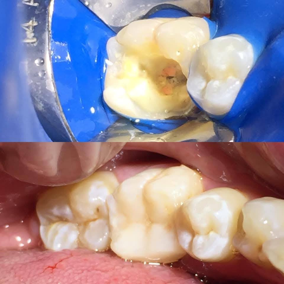 عيادة طب الاسنان الحديثة 
الدكتور علي كاظم رشيد القريشي 
حشوات ضوئية-قلع سن العقل-حشوات جذور
تنظيف و تبييض الاسنان الليزري -تركيب الاسنان الثابتة والمتحركة 
قضاء البدير-شارع الأطباء الطبي(بيت الحاج دريول) خلف مدرسة القاهرة مجاور صيدلية البديرالنموذجيه ***********
عيادة الدكتور علي كاظم القريشي لطب وزراعة وتقويم وتجميل الأسنان @إشارة
