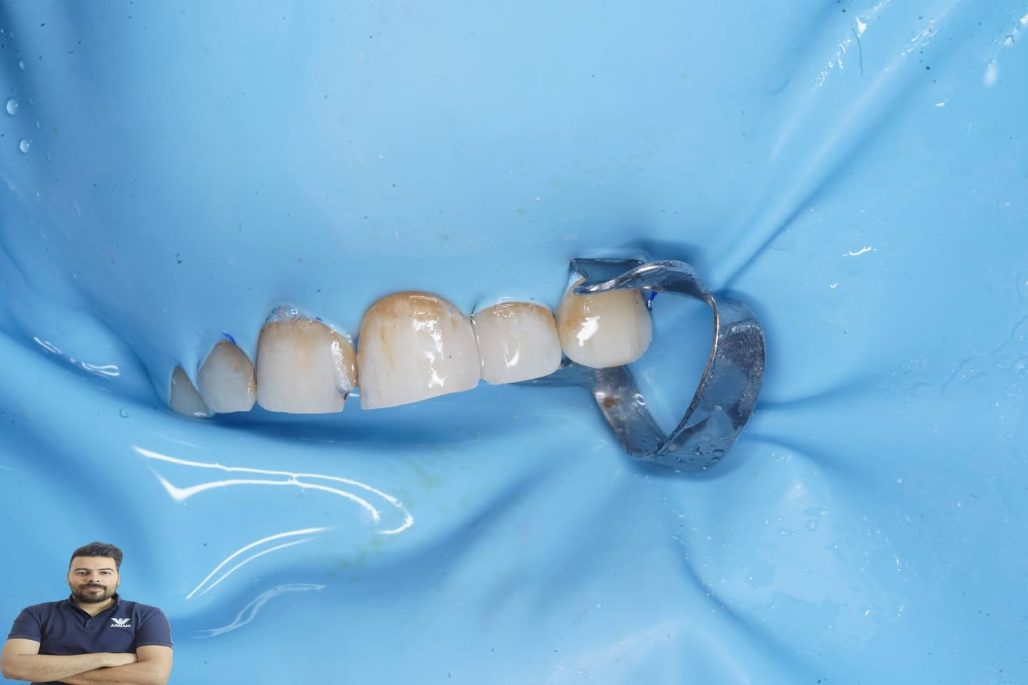 مراجعة عدهة تسوس بين الاسنان ومخرب شكلها سوينالهة حشوتين بحلسة واحدة ورجانة شكل الاسنان الطبيعي

العنوان /المسيب / شارع البلدية / مجاور عالم الحليب 

للحجز والاستفسار
***********
***********
