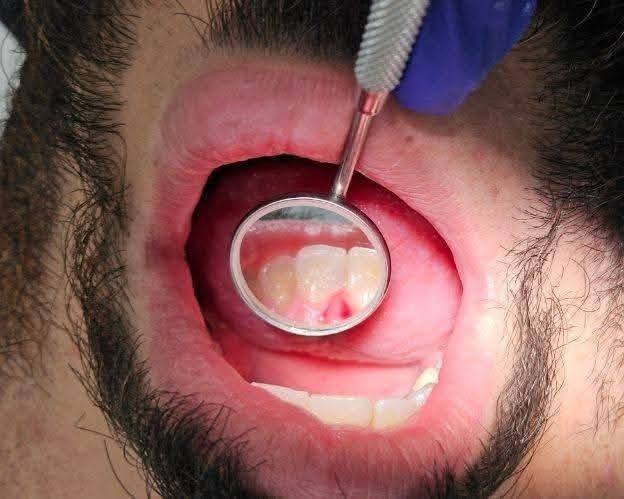 اي احد اسنانة بيها تصبغات او تكلسات هواية ومحتاج تنضيف اسنان (مجانا) او محتاج قلع اسنان او حشوات
يراسلني خاص او واتس اب ***********
