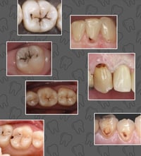 مجاناً الي عنده هيج تسوسات يتواصل وياي على الرقم  07751707470