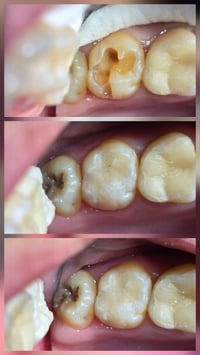 حشوة ضوئية • حشوة اسنان • عيادة اسنان • تجميل اسنان • طب اسنان • علاج ...