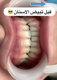 تبييض أسنان • تنظيف مجاني • خصم ٤٠٪