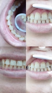 مجانا مجانا مجانا تنظيف الاسنان وازالة التكلسات حشوات ضوئية تجميليه قل...