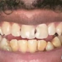 ورحمه الله وبركاته الي عندة تسوسات بأسنانه تشبه هاي الصور او كسر بلأسن...