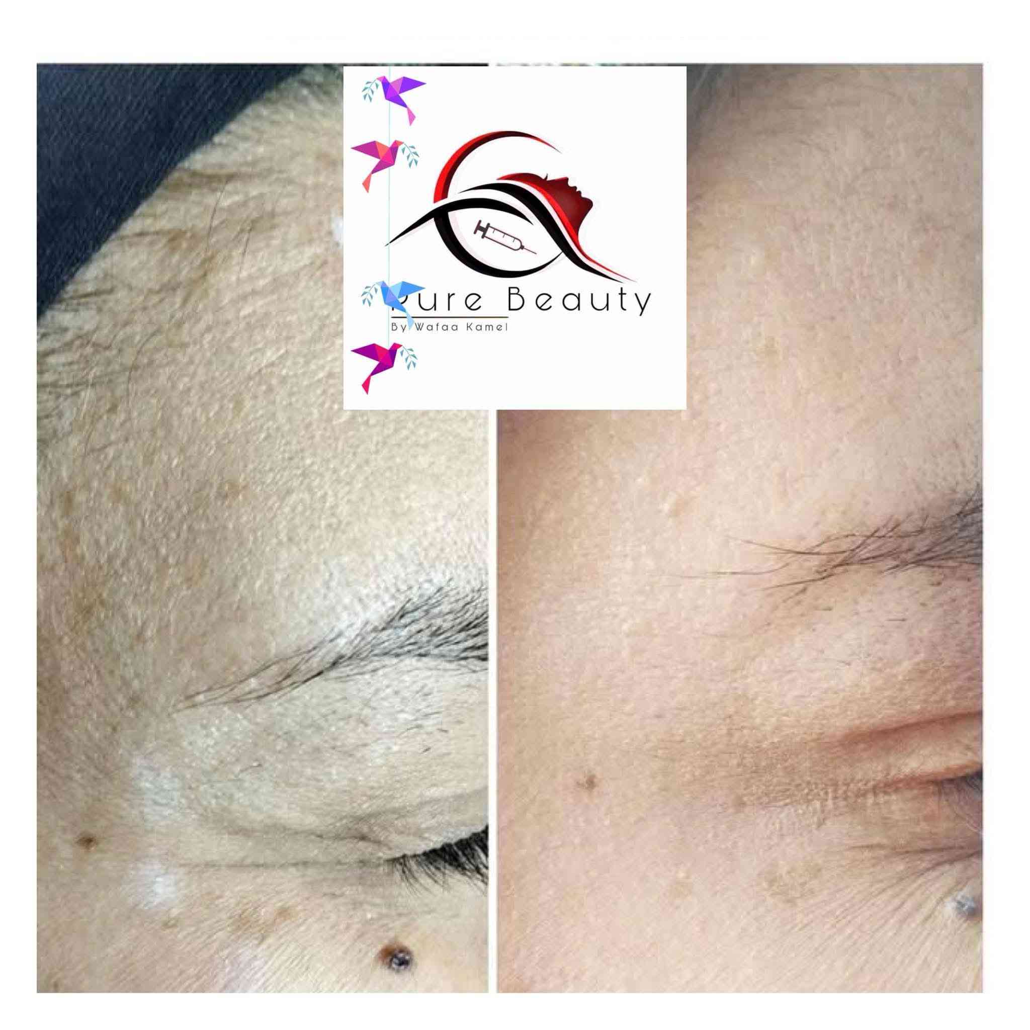 هلاو يا بنات 🥰💖 العيد قرب وحان الوقت لتبرزي جمالج الطبيعي بأحلى شكل! ✨
مع Pure Beauty للتجميل الجراحي، كل عملية تجميل عندنا بتكون احترافية وفخمة، والتفاصيل الصغيرة تصنع فرق كبير 😍💎
والأفضل؟ عروضنا الخاصة رح تخلي التجربة أكثر مغرية وكل بنت رح تحس بالتميز 🔥💫
📍 المكان: داخل مجمع بسمايه السكني
📲 للحجز: واتساب ***********
دللي نفسك وخلي جمالك يتألق بأمان واحترافية 😘✨
https://www.facebook.com/share/1C9cHiuph9/?mibextid=wwXIfr
