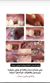 تنظيف أسنان حشوات قلع بدون ألم والاستشارة مجانــي  07764472309
