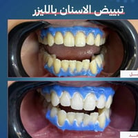 عيد الأضحى • عيادة الرسالة • تنظيف أسنان