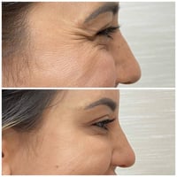 بوتكس • رفع حاجب • فلكة الكمالية