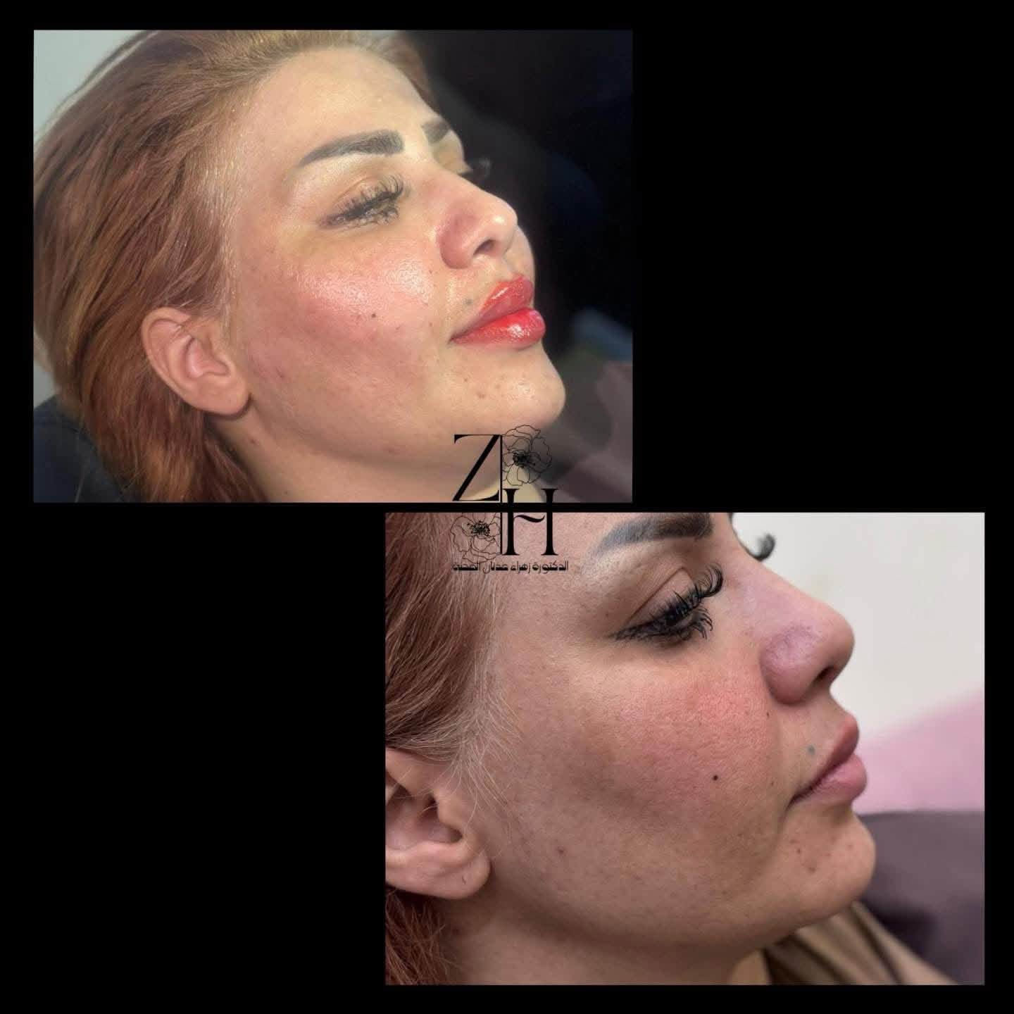 عروض عيادة الدكتورة زهراء عدنان المحنة✨💕

فلر عشرة سيسي + 
بوتكس
+ نضاره✨🤭
وتنظيف بشرة هدية✨✨✨🦋

كل هالجمال ب٣٠٠ الف فقط
وتدللون ياحلوات ✨✨

(العروبة داخل فرع مثلجات حسين وسنتر دولار)

للحجز والاستفسار التواصل على الخاص او الاتصال على الرقم التالي

📞***********
