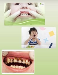 جامعة واسط • علاج مجاني • أسنان أطفال