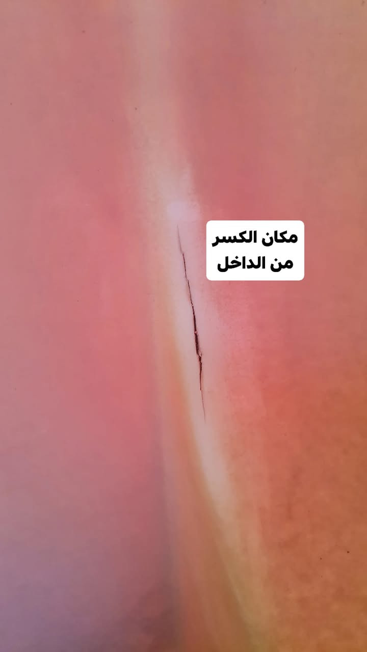 #🔰تصليح خزانات الماء البلاستك
🔰 🔴 (((ضمان سنه كامله))) 🔴
🔰يتوفر تصليح موقعي داخل المنزل 
🔰اترك عنوانك ونجيك الباب 
البيت ***********
