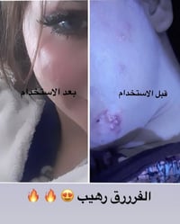 تفتيح • شد الوجه • بديل ابرة نضارة