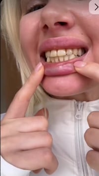 تبيض سنان • اسنان صحية • خاص