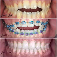 تقويم معدني • علاج أسنان • د أحمد المحمدي