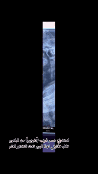 استخراج جسم غريب (دنبوس) من البلعوم تحت التخدير العام لطفل يبلغ عمرهُ ١٠ اشهر 

العنوان : حلة / شارع الطهمازية / مقابيل مستشفى التركي / مجمع  الخليج الطبي
أوقات الدوام طول ايام الأسبوع من الساعه ٤:٠٠ عصرا إلى الساعة ٨:٠٠ مساءا 
الجمعة من الساعة ٩:٠٠ إلى الساعة ١٢:٠٠ 
الخميس و الأحد عطلة العيادة

 رقم العيادة ***********
