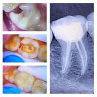 حشوة جذر للسن الخلفي طبيب الاسنان الاختصاص د.عمار عباس ماجستير تقويم و...