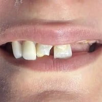 تركيبات زيركون • حشوات جذر • ابتسامة طبيعية
