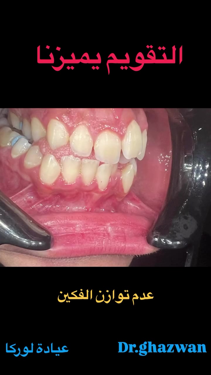 التقويم يميزنا احد اعقد و اصعب الحالات عدم توازن الاطباق و عدم توازن الفكين مشاكل في المظهر الخارجي انزعاجات اثناء الاطباق و اثناء تناول الطعام و الكلام عدم الارتياح اثناء النوم بروز حاد و عدم القدرة على تنظيف الاسنان…. علاج جميع الحالات الصعبة و المستعصية نحاول على عدم او تقليل من المشاكل اثناء فترة العلاج من خلال الخبرة لكثير من الحالات ( عدم سقوط النجمات او الجهاز) دكتور غزوان مزهر بغداد الكرخ نفق الشرطة بداية شارع الاطباء عيادة لوركا فوق صيدلية كنز النفق متوفر واتس *********** #تقويم_الأسنان_والفكين #تقويمالأسنان #تقويم_الأسنان_بأنواعه #تقويم_الشفاف_للأسنان #تقويم_الأسنان_قبل_وبعد @تقويم_الاسنان @العضة_المعكوسة @تقدم_الفك_السفلي @تقدم_الفك @العضة_المفتوحة @العضة_العميقة
