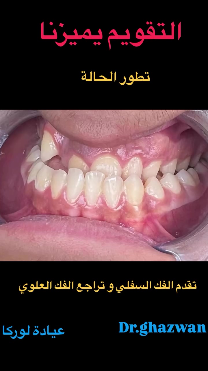التقويم يميزنا احد أروع النتائج لاحد الحالات تقدم الفك السفلي و تراجع الفك العلوي مصاحب لمظهر غير متناسق و مشاكل في تناول الطعام و نطق الحروف و الكلام و انزعاجات و الم اثناء الحركة و الدور الوظيفي مستمرون حتى نهاية العلاج … علاج جميع الحالات الصعبة و المستعصية تقويم الأسنان بالتقسيط جلسات علاج التقويم مجانيه… دكتور غزوان مزهر بغداد الكرخ نفق الشرطة بداية شارع الاطباء عيادة لوركا فوق صيدلية كنز النفق متوفر واتس *********** #تقويم_الأسنان_والفكين #تقويمالأسنان #تقويم_الأسنان_بأنواعه #تقويم_الأسنان_قبل_وبعد #تقويم_الشفاف_للأسنان
