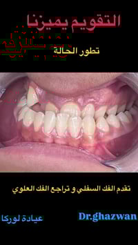 التقويم يميزنا احد أروع النتائج لاحد الحالات تقدم الفك السفلي و تراجع ...