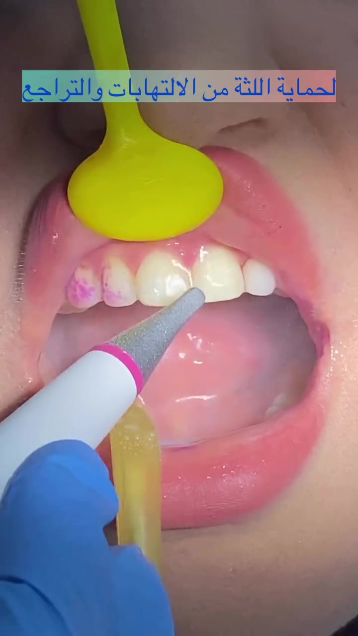 للحجز و الاستفسار مراسلة الصفحة او الاتصال عبر الرقم :#dental ***********
