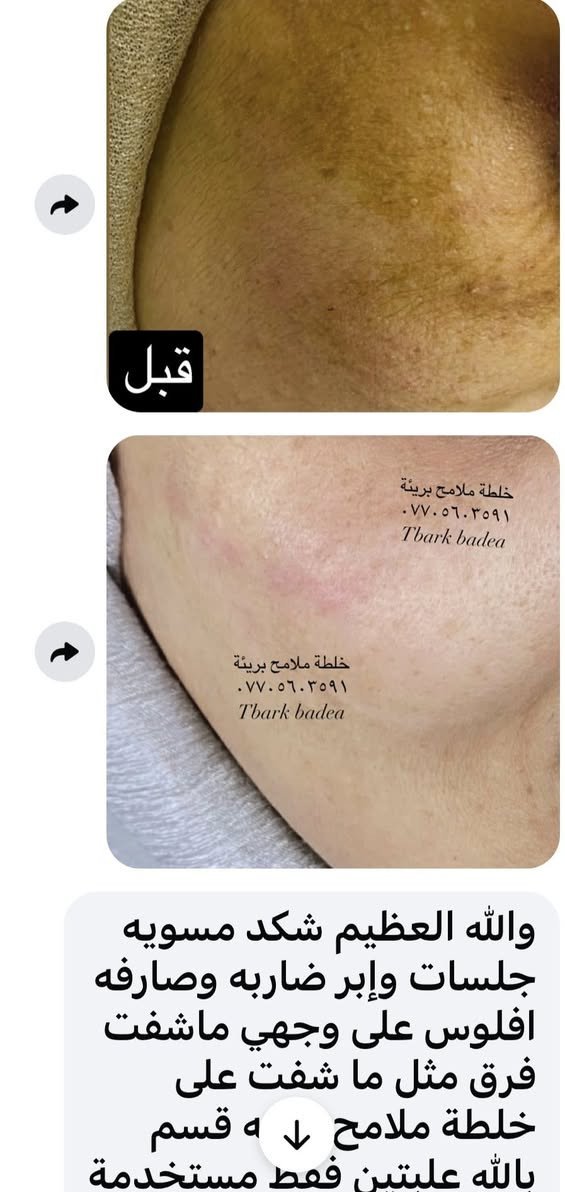وتستمر خلطة ملامح بريئة بأثبات مفعولها بنتائج مبهرة 🫶


**إذا كنت صاحب هذا الإعلان وتريد حذفه لأي سبب، رجاءا أرسل رسالة إلى الدعم الفني**