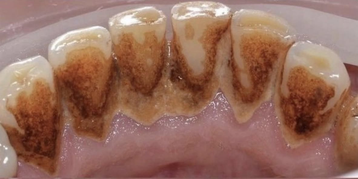 تنظيف اسنان مجاني للاسنان الي مثل الصور في البصرة والزبير للتواصل ***********
