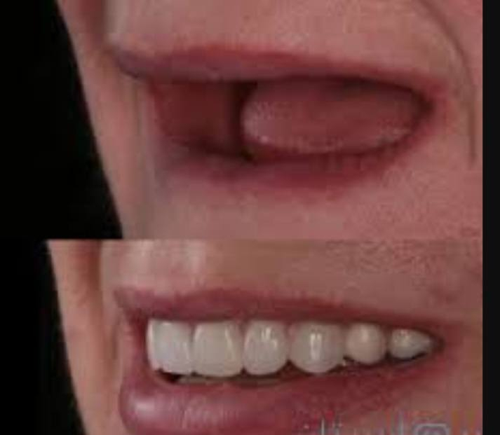 السلام عليكم تعلن عيادات جامعة بابل / كلية طب الاسنان 
إستقبال الحالات التالية  (مجانا) فقط سعر الباص  :
1_قلع الاسنان والجذور التالفه.
2-حشوات دائمية ضوئية وحشوات جذور.
3-تعويض الاسنان المفقودة بطقم كلي 
4-تنظيف الاسنان وازالة التكلسات.
5- معالجة اسنان الاطفال(قلع الاسنان اللبنية/حشوات/تنظيف/وقاية الاسنان من التسوس بإستخدام الفلورايد).
6_  تقويم اسنان متحرك
7_ مشاكل في الفك الصدغي وتقرحات في الفم واللسان 
 للحجز والاستفسار تواصل على الخاص 
او واتساب على الرقم📞 :-  ***********
العنوان🗺 : عيادات طب الاسنان_ حي الاسكان_ قرب الكراج الموحد
