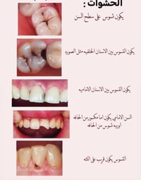 طالبة خامسة طب أسنان • جامعة الموصل • طقم متحرك