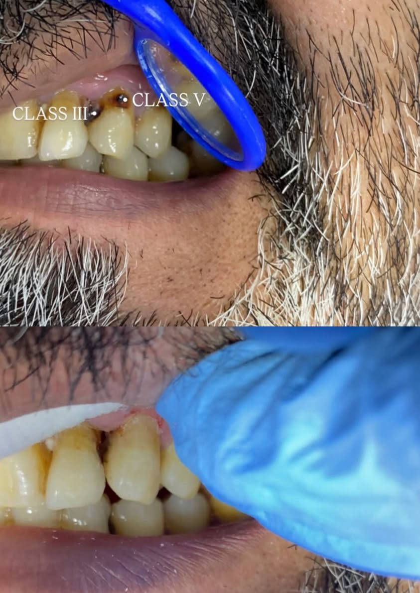 علاج اسنان مجاني في عيادات جامعة المنارة
للحجز الاتصال على الرقم 
 ‏‪0770 702 4073‬‏
