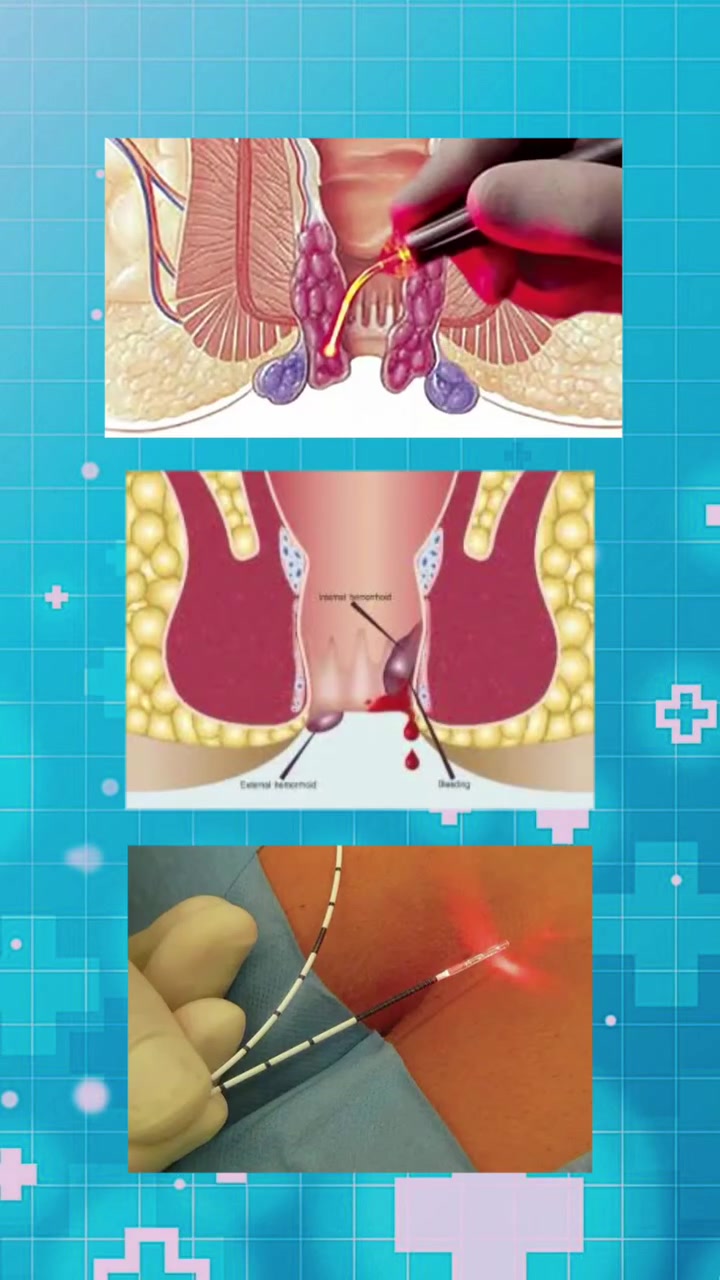 #اعلان 
 الدكتور عمار القيسي – أخصائي الجراحة العامة

بقدم لكم أحدث التقنيات الطبية باستخدام الليزر وبدون ألم يذكر، وبـالتخدير الموضعي:

✔️ علاج الناسور
✔️ علاج البواسير
✔️ علاج الفطر الشرجي
✔️ عمليات شفط التثدي لدى الرجال

✨ مميزات العمليات:
– بدون تخدير عام
– إجراء سريع وآمن
– فترة تعافي قصيرة
– نتائج مضمونة بإذن الله

📞 احجز موعدك اليوم وارتاح من المعاناة
📍 خبرة + تقنية حديثة = نتيجة مضمونة
*********** يوجد واتساب

الموقع : الطارمية - شارع الشهداء - مجمع دار الامل الطبي مجاور حلويات والت دزني
